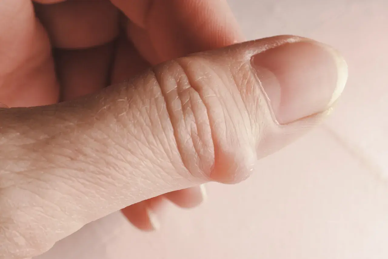 Nahaufnahme eines Daumens mit einem sichtbaren Ganglion am Finger.