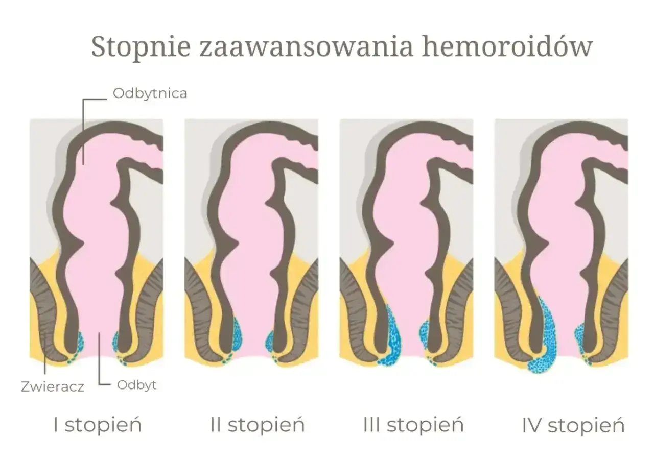 Ilustracja przedstawia cztery etapy rozwoju hemoroidów zewnętrznych, od I do IV stopnia, pokazując ich stopniowe powiększanie się.