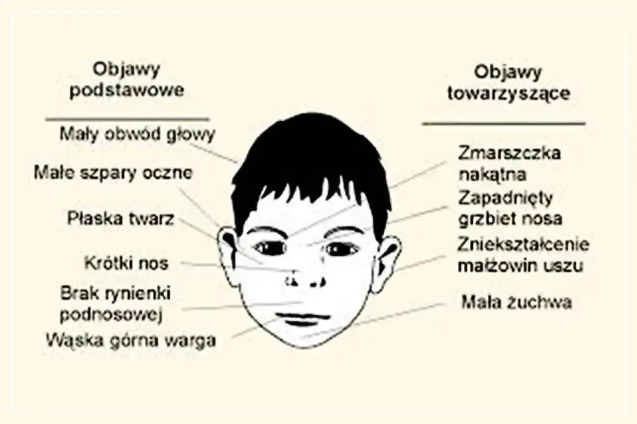 Ilustracja przedstawia twarz dziecka z zaznaczonymi objawami, które mogą wskazywać na zespół FAS.