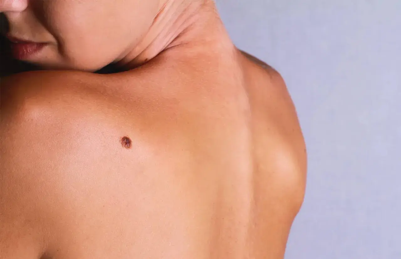 Gros plan sur une épaule et le cou d'une personne, avec un grain de beauté qui dépasse sur la peau bronzée.
