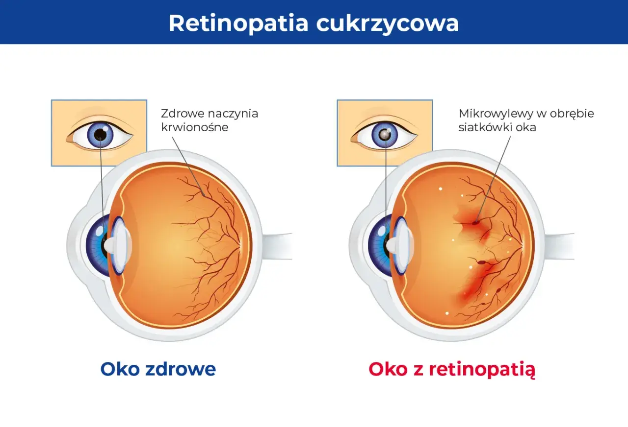 Porównanie zdrowego oka z naczyniami krwionośnymi siatkówki i oka z retinopatią cukrzycową, gdzie widoczne są mikrowylewy.