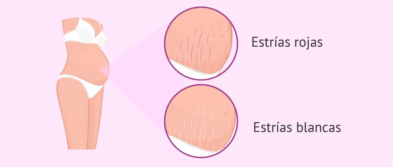 Ilustración de abdomen de embarazada con primeros planos de estrías rojas y blancas, mostrando las marcas comunes del embarazo.