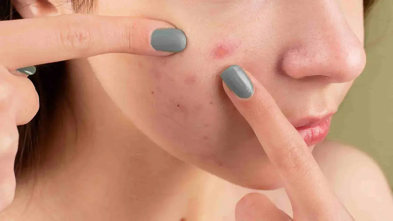 Dita che toccano il viso con acne, un gesto che può peggiorare la dermatillomania come smettere.