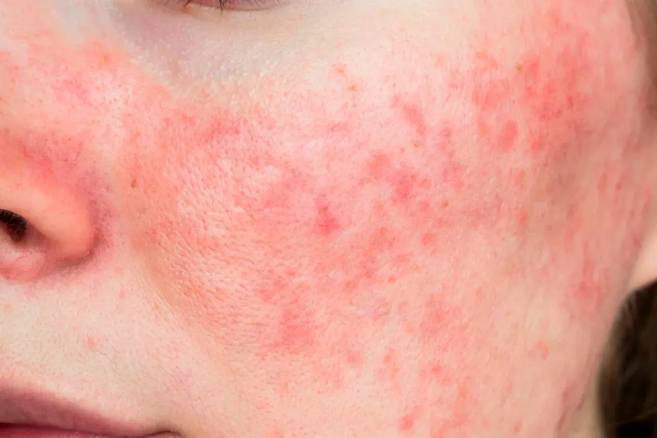 Rostro con enrojecimiento y pequeños bultos, indicativo de rosacea leve.