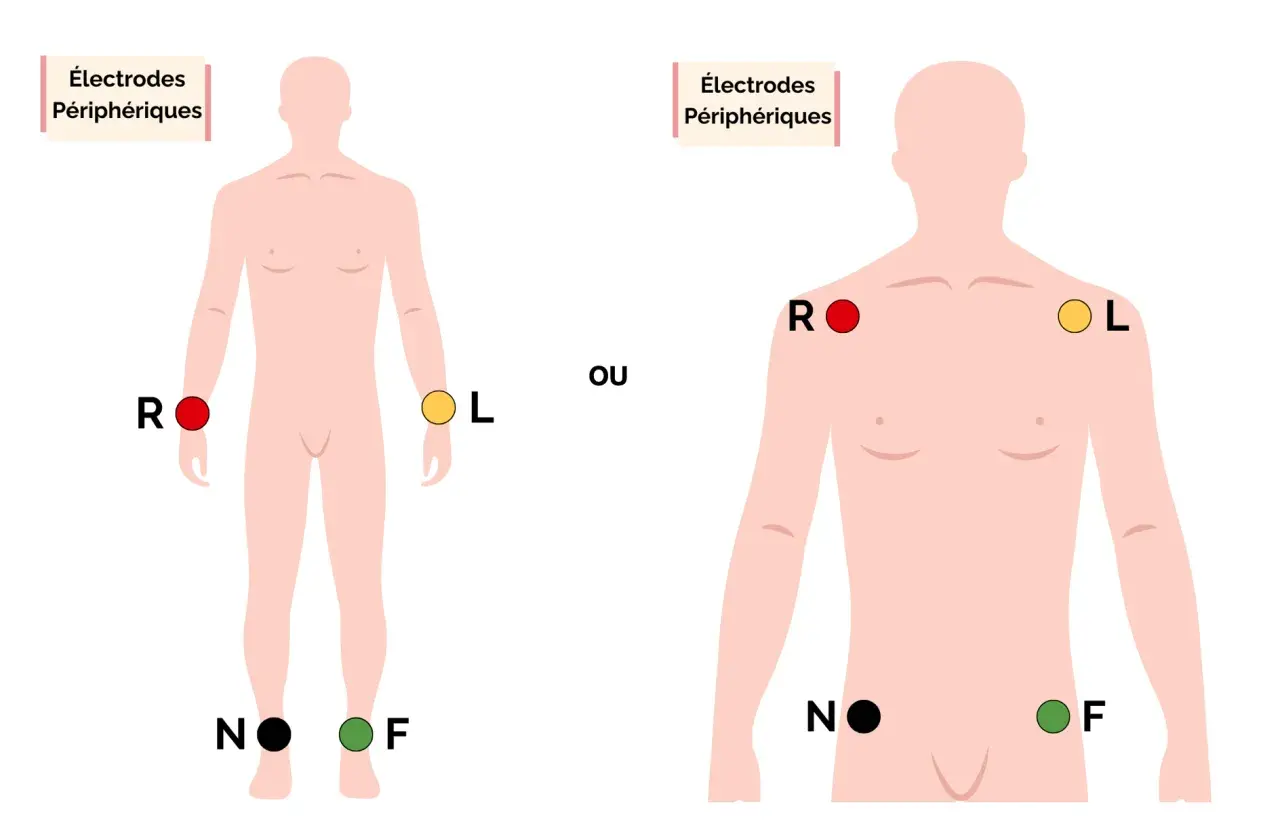 Schéma montrant le placement des électrodes périphériques pour un ECG.