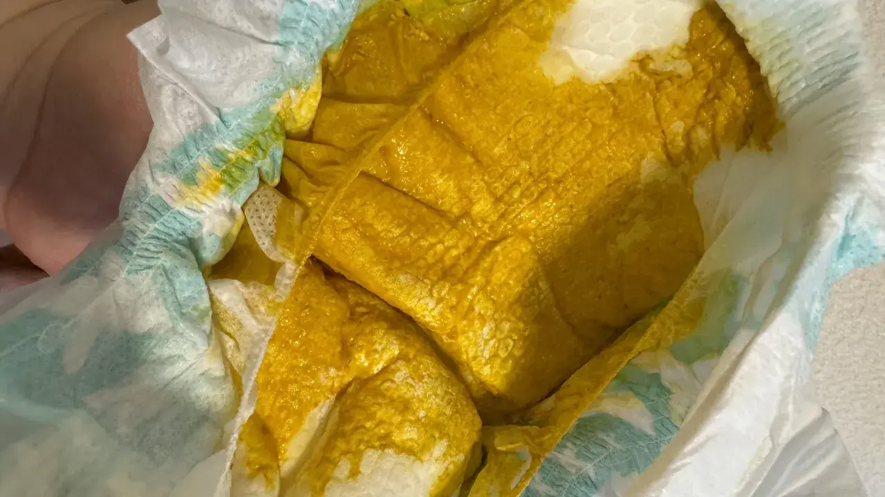 Pannolino con feci gialle e liquide, indicative di diarrea neonato. La consistenza è molto morbida e acquosa.