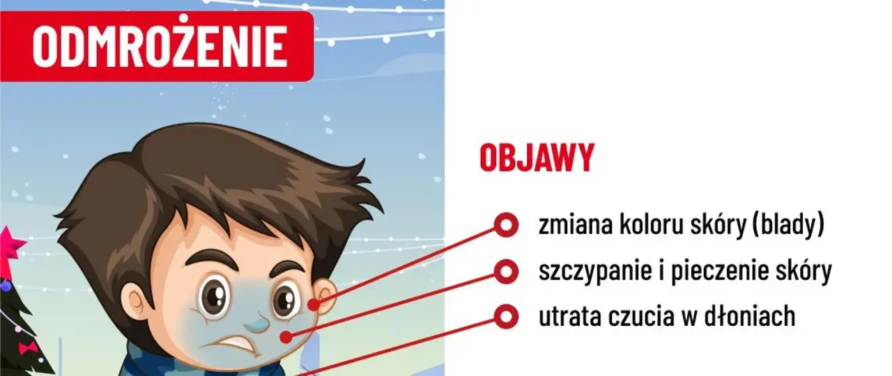 Chłopiec z bladą skórą i zmarzniętymi dłońmi, objawy odmrożenia: bladość, pieczenie, utrata czucia.