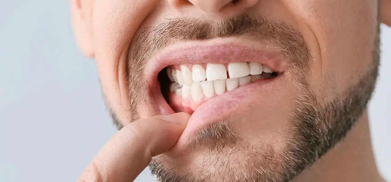 Primo piano di un uomo che mostra i denti e le gengive. Si nota un dito che solleva il labbro, evidenziando le gengive ritirate.