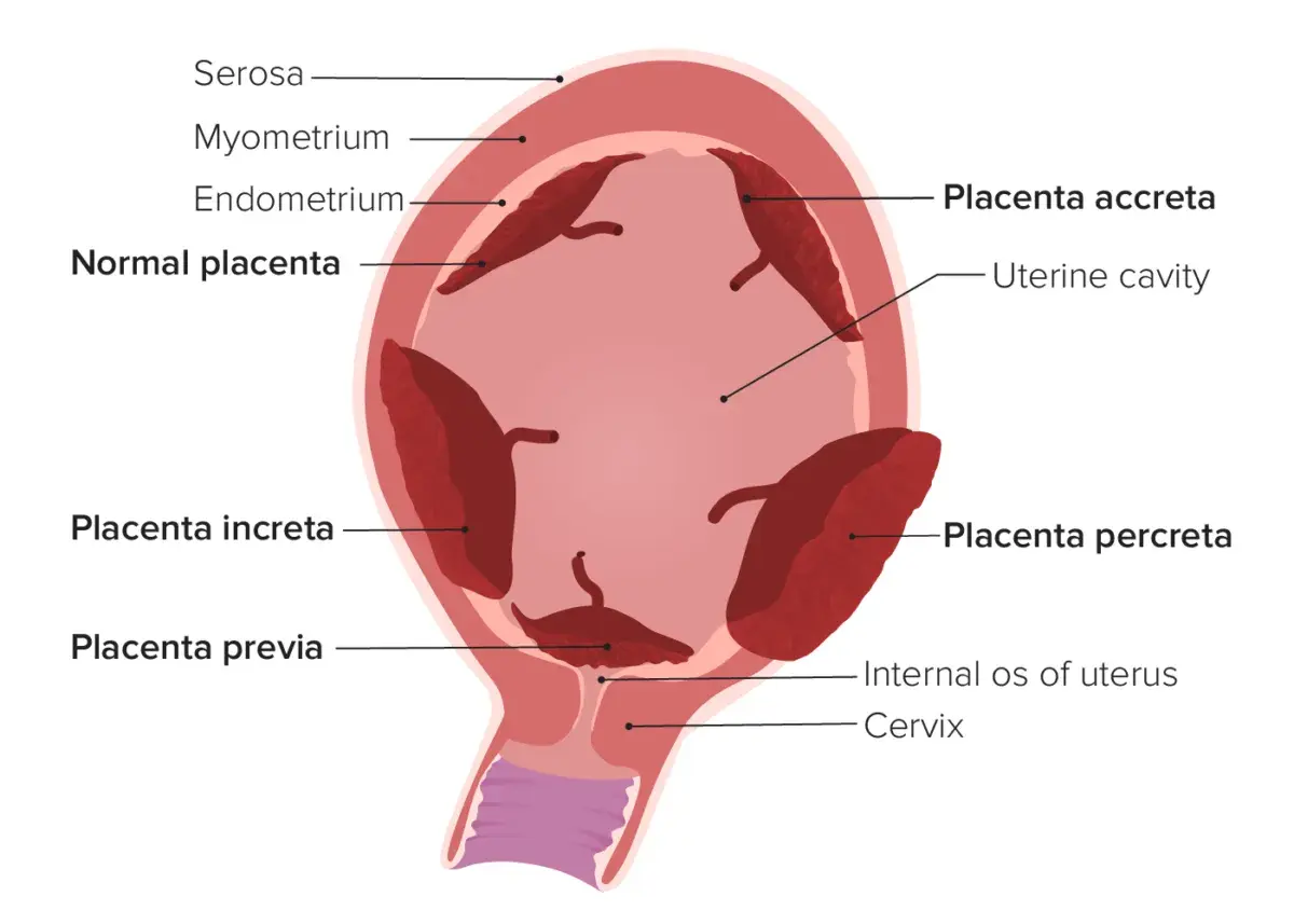 Schematische Darstellung des Uterus mit verschiedenen Plazentapositionen. Was ist die Plazenta? Sie ist ein Organ, das sich während der Schwangerschaft entwickelt.