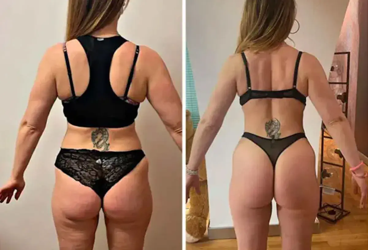 Prima e dopo: la trasformazione di una donna con glutei perfetti, più tonici e scolpiti.
