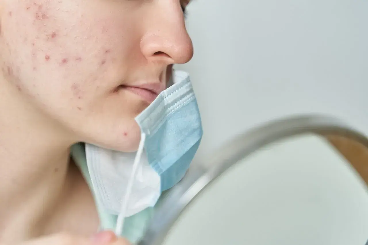 Primo piano di un viso con evidenti segni di acne da mascherina. La persona tiene una mascherina blu e bianca vicino al mento.