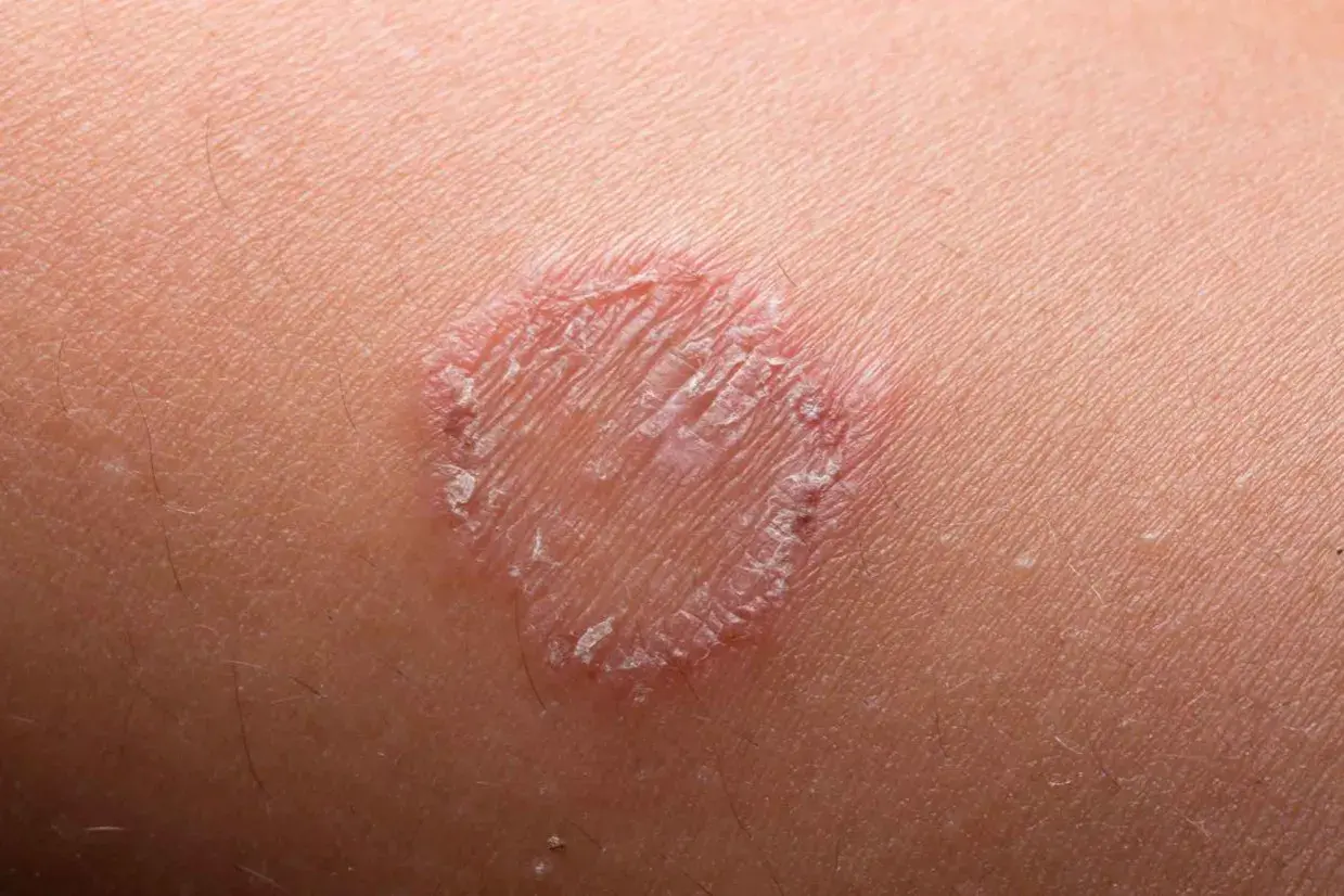 Macchie rosse sulla pelle, un'infezione fungina che forma un anello squamoso.