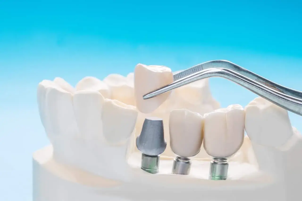 Un dente incapsulato viene posizionato con una pinzetta su un impianto dentale, parte di un modello di mascella.