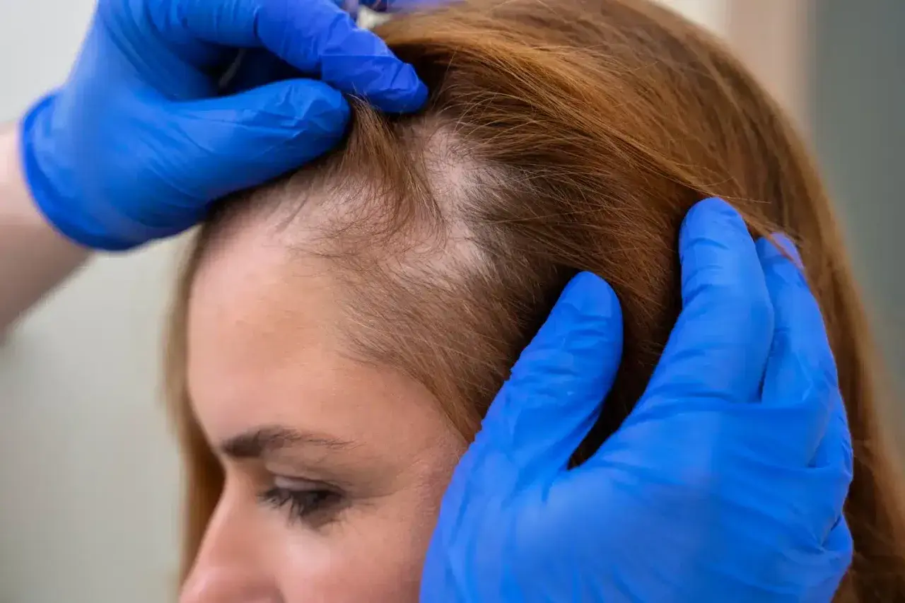 Manos enguantadas revisan el cuero cabelludo de una mujer, mostrando áreas de pérdida de cabello que podrían indicar un cuero cabelludo quemado.