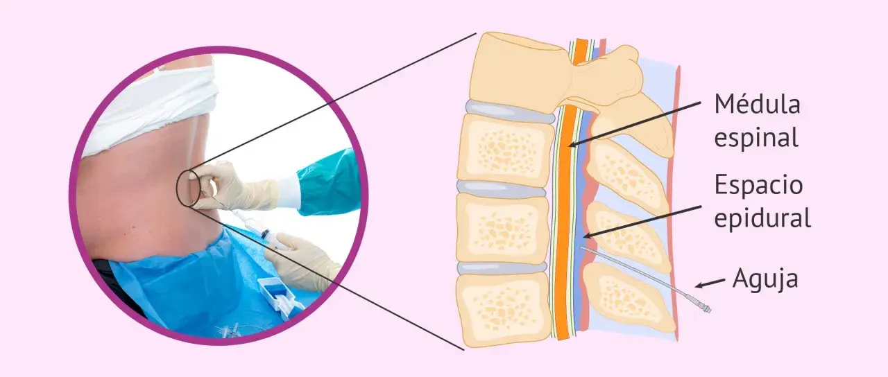 Ilustración de una inyección epidural. Una aguja se inserta en el espacio epidural de la columna vertebral. Puede haber dolor epidural meses después.
