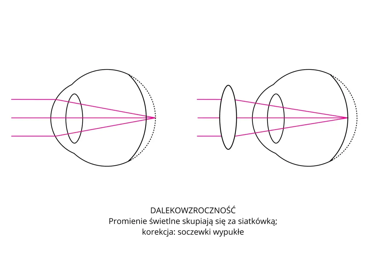 Schemat budowy oka z dalekowzrocznością. Promienie światła skupiają się za siatkówką. Korekcja soczewką wypukłą.