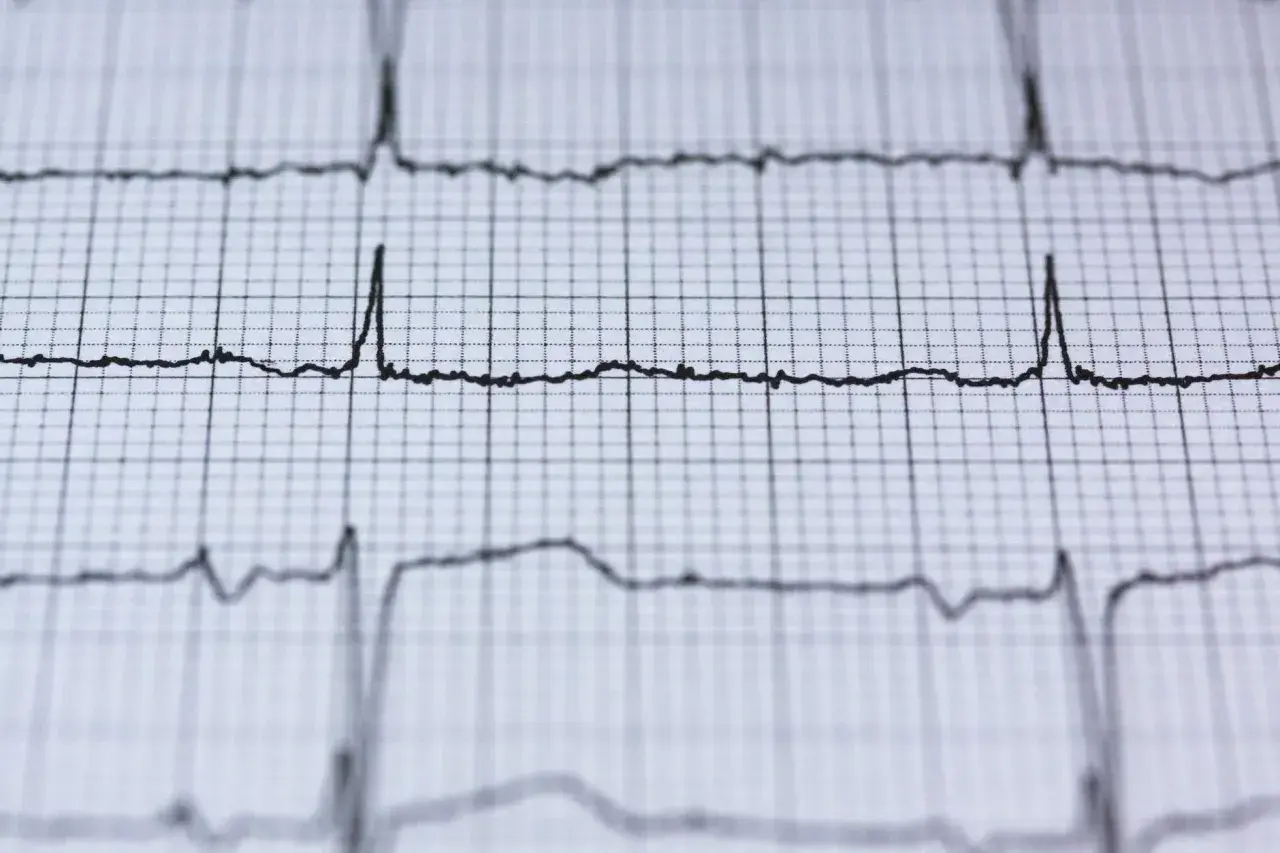 EKG pokazuje rytm serca. Czy nerwica serca wyjdzie na EKG? Zapis pokazuje fale, które mogą być interpretowane przez lekarza.