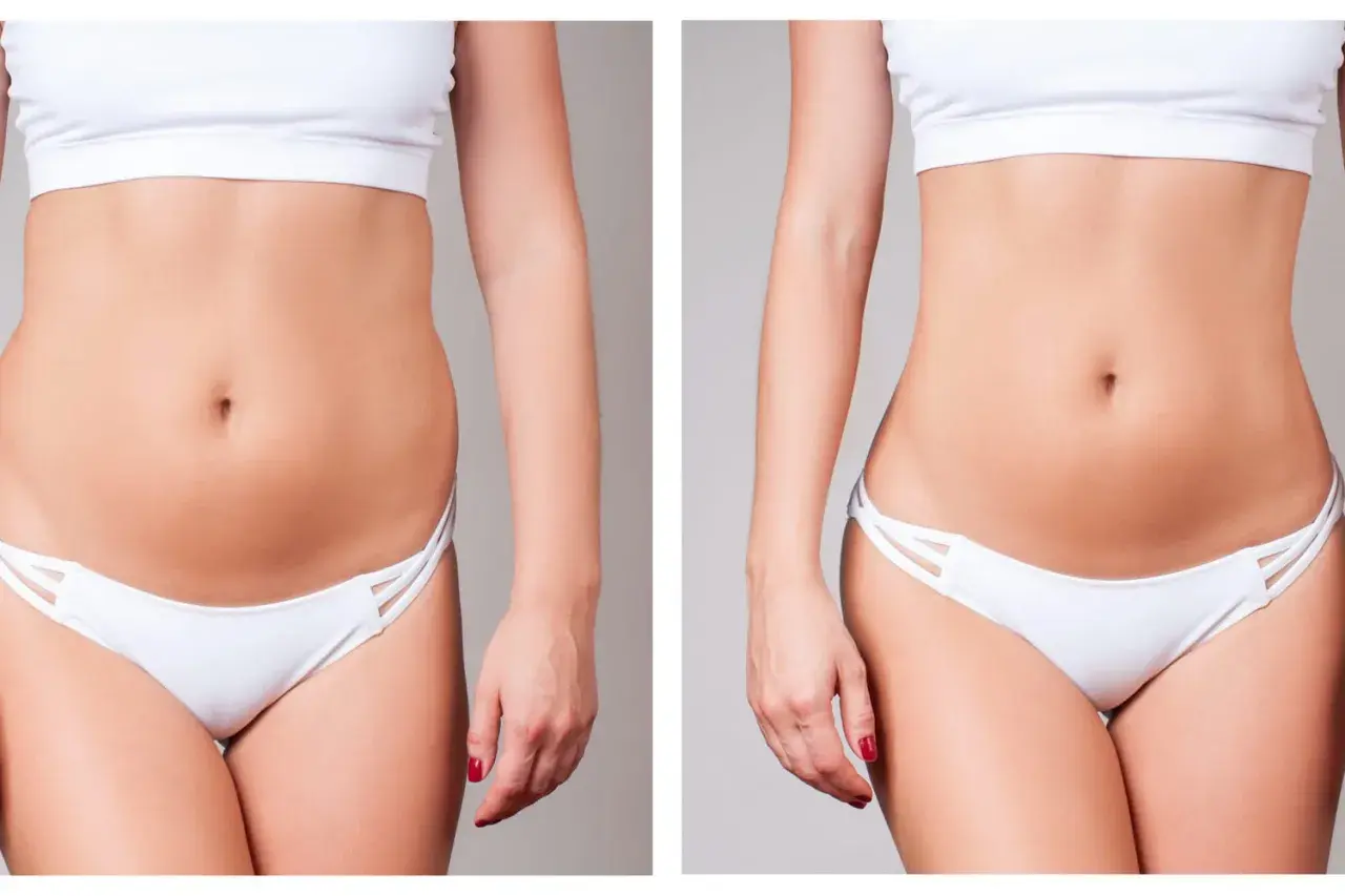 Avant/après d'une liposuccion ventre. Une silhouette affinée et une taille plus marquée après l'intervention.