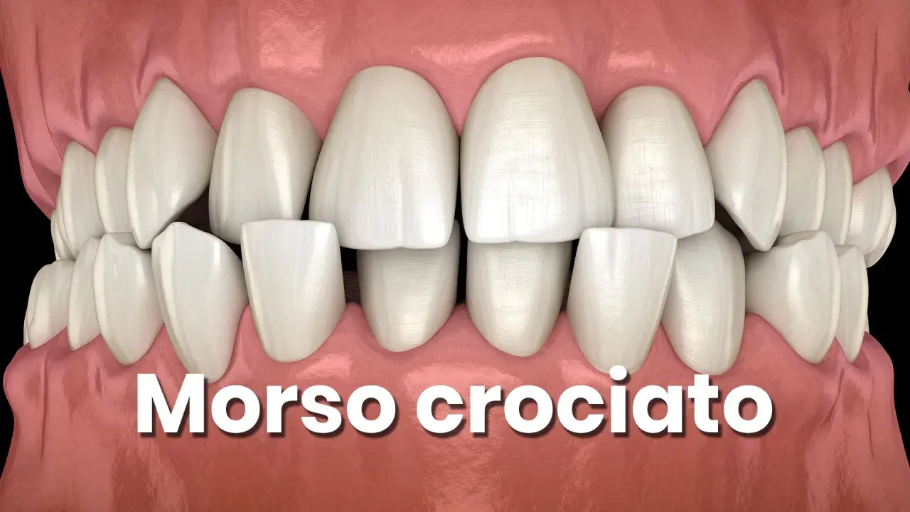 Denti bianchi e sani con un evidente morso incrociato, dove i denti superiori coprono parzialmente quelli inferiori.
