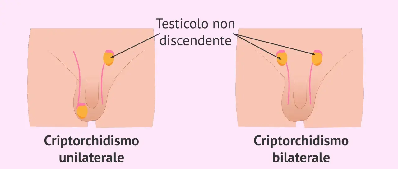 Illustrazione medica che mostra il criptorchidismo, una condizione in cui un testicolo non è sceso. Il testicolo ritenuto bambino 10 anni può essere unilaterale o bilaterale.
