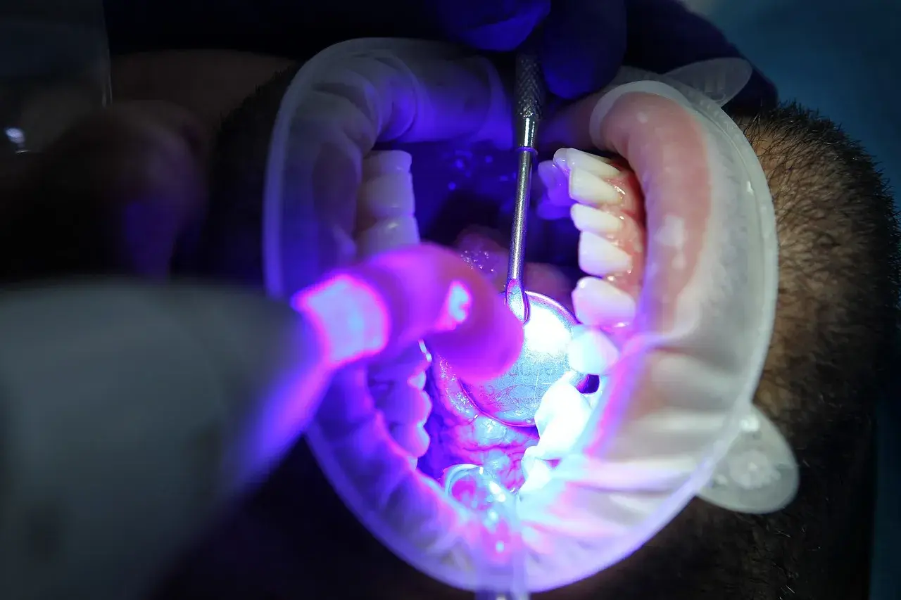 Zabieg stomatologiczny: jak wybielić martwy ząb. Dentysta używa lampy UV i narzędzi do wybielania zęba.