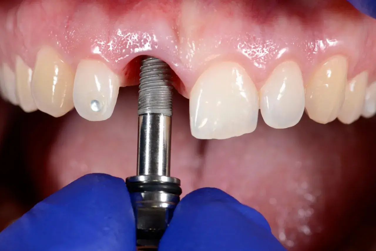 Zabieg wszczepienia implantu dentystycznego w szczękę. Widoczne są zęby, dziąsła i narzędzie stomatologiczne.
