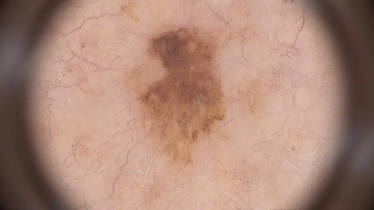 Dermatoskopische Aufnahme eines unregelmäßigen, braunen Muttermals mit feinen Gefäßen. Ein frühes Melanom zeigt sich oft so.