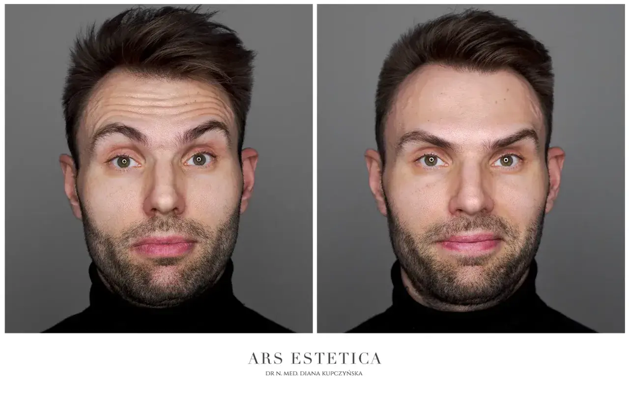 Przed i po zabiegu botoxu. Widoczne wygładzenie zmarszczek na czole, dzięki precyzyjnym botox miejsca wstrzyknięć.