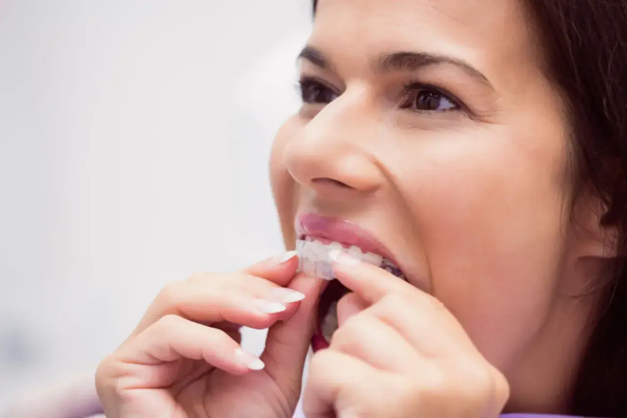 Mujer ajustando su ortodoncia invisible. Un tratamiento que también ayuda a prevenir la periodontitis.