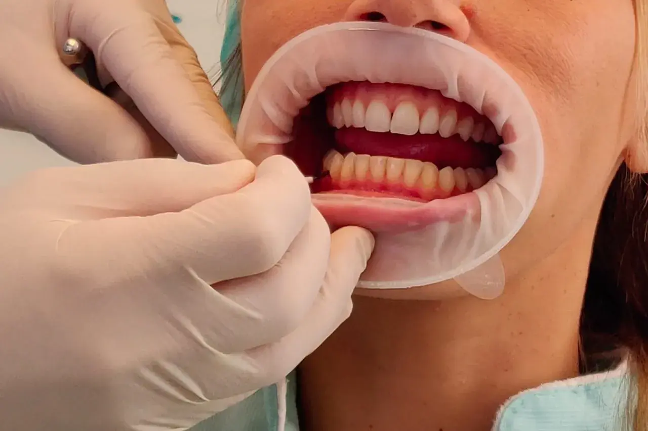 Mani guantate usano scovolini denti per pulire tra i denti di una persona con un divaricatore orale.