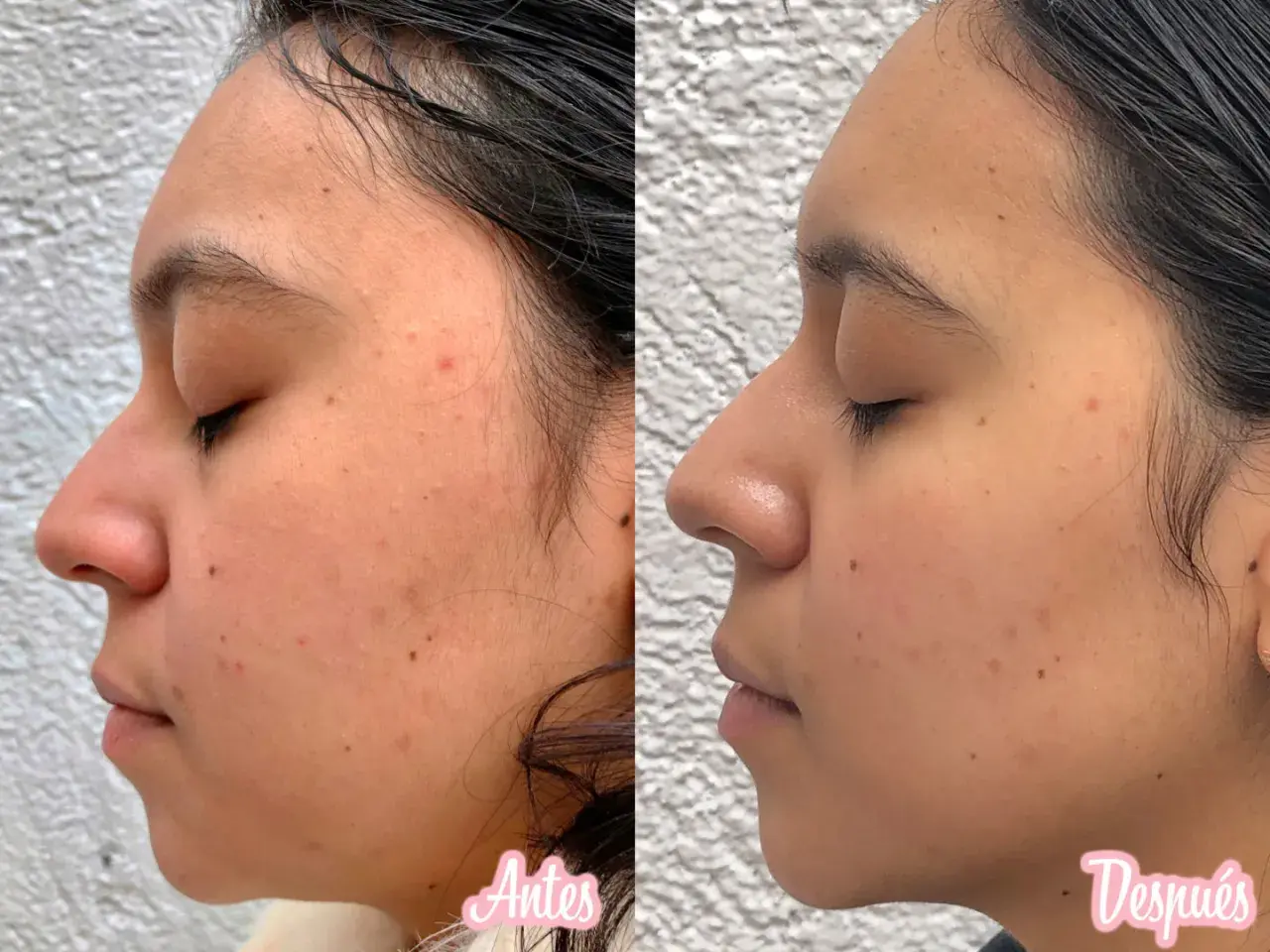 Comparativa de piel con acné y marcas. El lado "antes" muestra imperfecciones, mientras que el "después" revela una piel más lisa tras usar vitaminas para la cara.