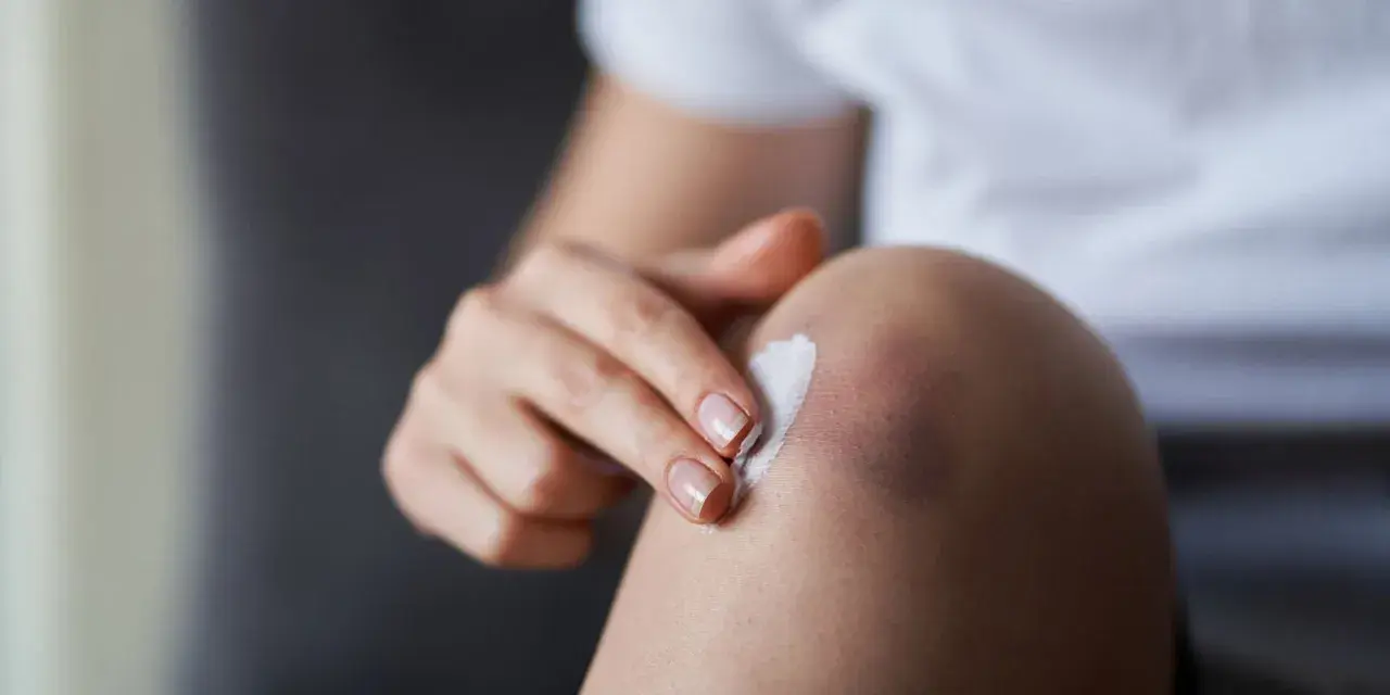Eine Hand trägt Salbe auf ein blaues Fleck am Knie auf. Die **Prellung am Knie** wird vorsichtig behandelt.