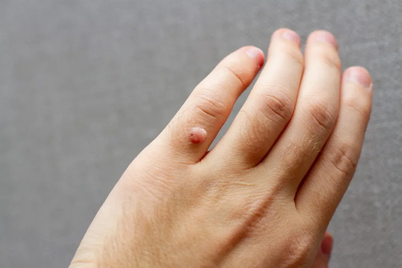 Närbild på en hand med en vårtliknande utväxt på ett finger. Det ser ut som att man vill dra ut vårta.