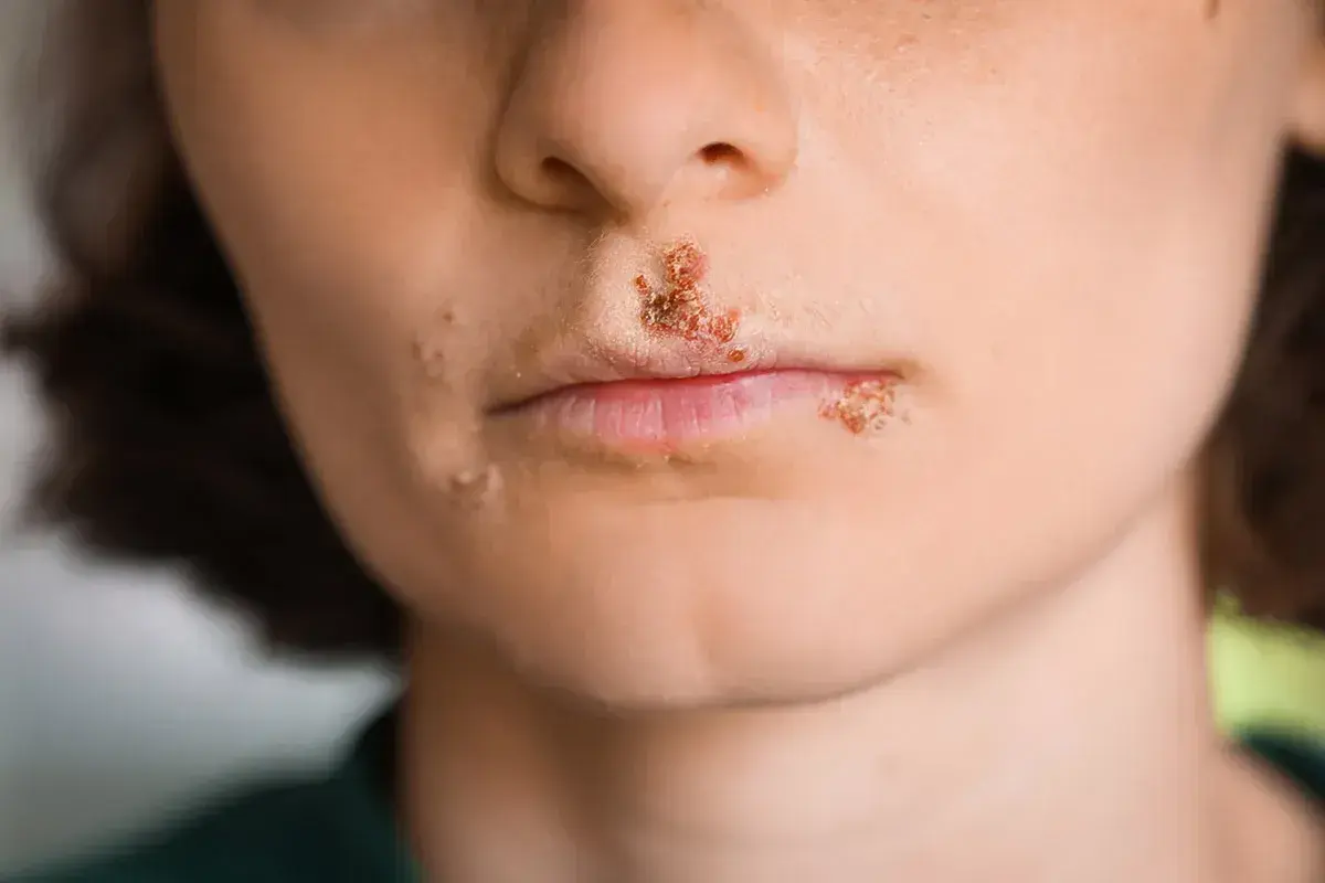 Bocche con lesioni tipiche di stomatite erpetica, con vescicole e croste sulle labbra e intorno alla bocca.
