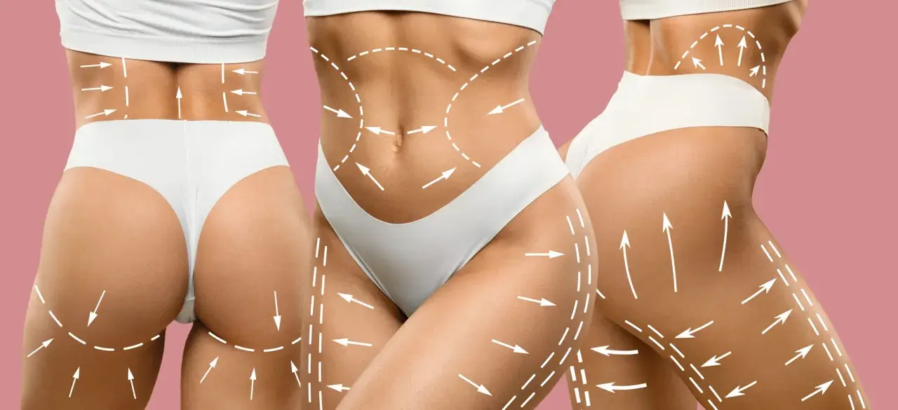 Liposukcja: Co to jest, dla kogo, jak przebiega i ile kosztuje?