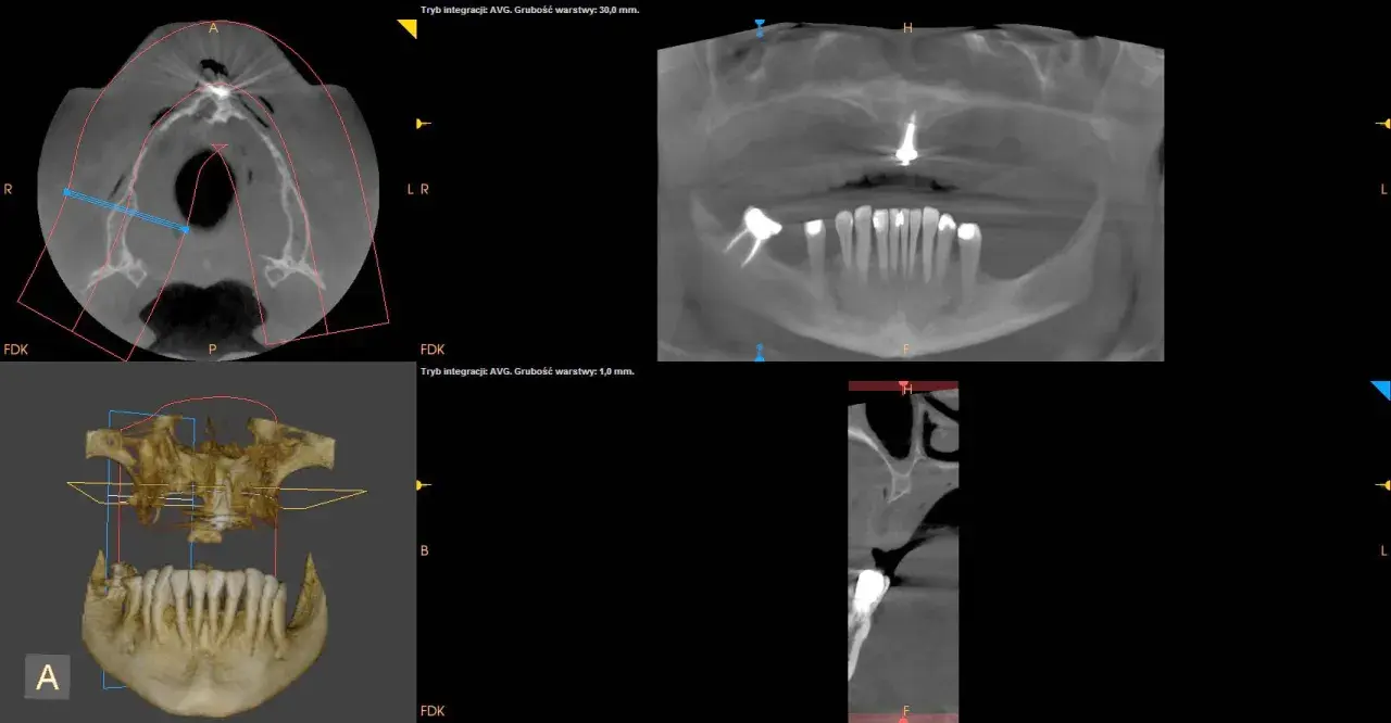 Badanie CBCT pokazuje przekroje zębów i szczęki. To nowoczesna metoda diagnostyki stomatologicznej.