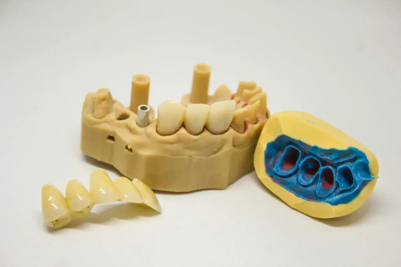 Model szczęki z implantami i mostkiem. Obok model wyciskowy szczęki. Proteza szkieletowa bezklamrowa w przygotowaniu.