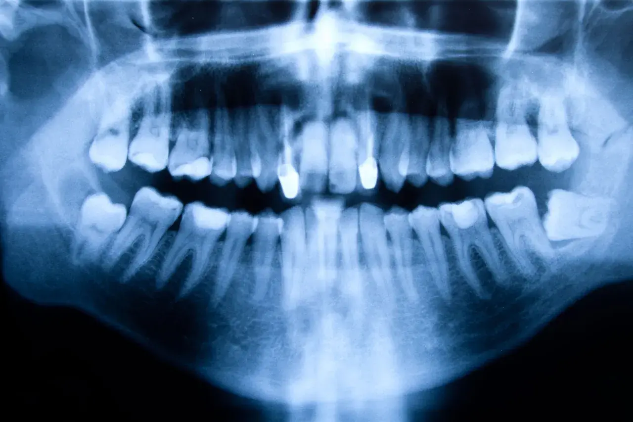 Radiografía panorámica dental que muestra una anomalía ósea, posiblemente un quiste en la boca, afectando la mandíbula inferior.