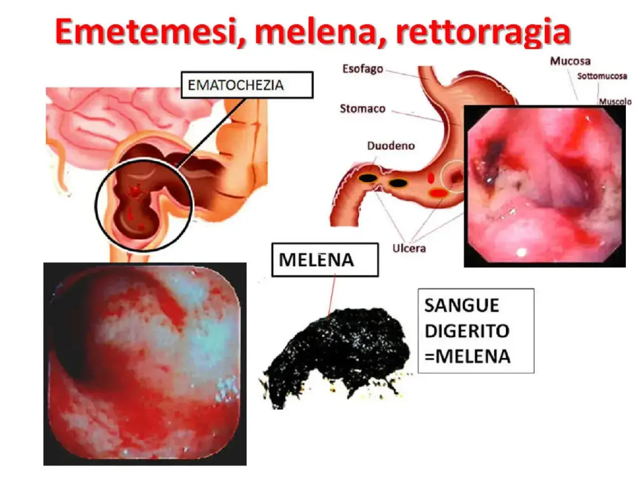 Illustrazione medica che mostra ematochezia e melena, sintomi di sanguinamento gastrointestinale, inclusa la presenza di sangue nelle feci.