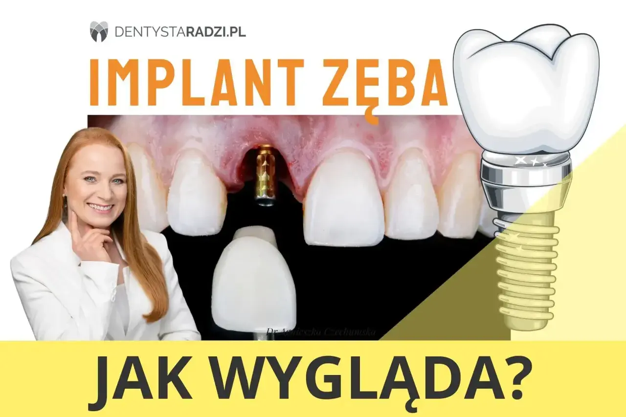 Zobacz, jak wygląda implant zęba: złoty element wkręcony w dziąsło i jego schematyczny rysunek z koroną.