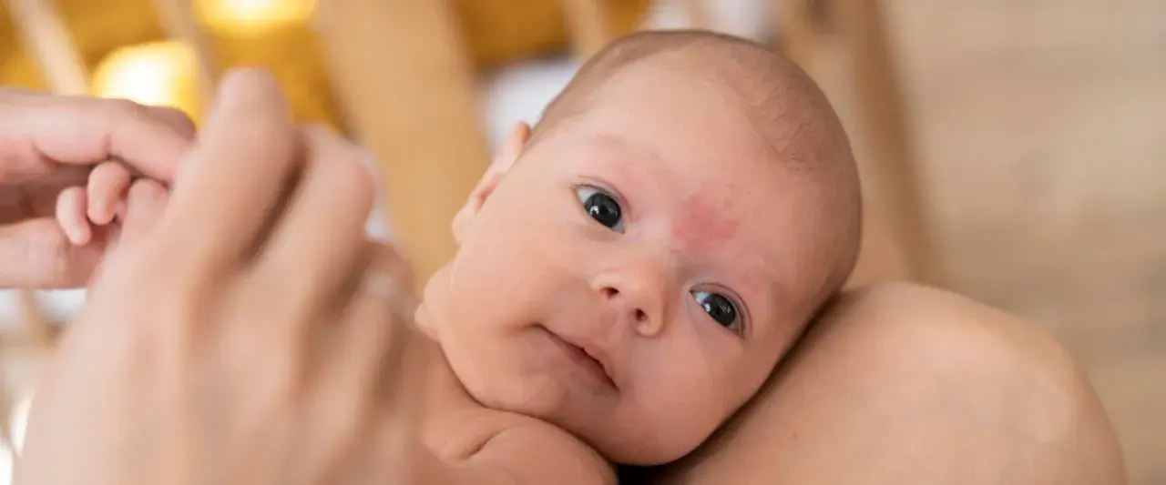 Primo piano di un neonato con pelle screpolata, tenuto in braccio.