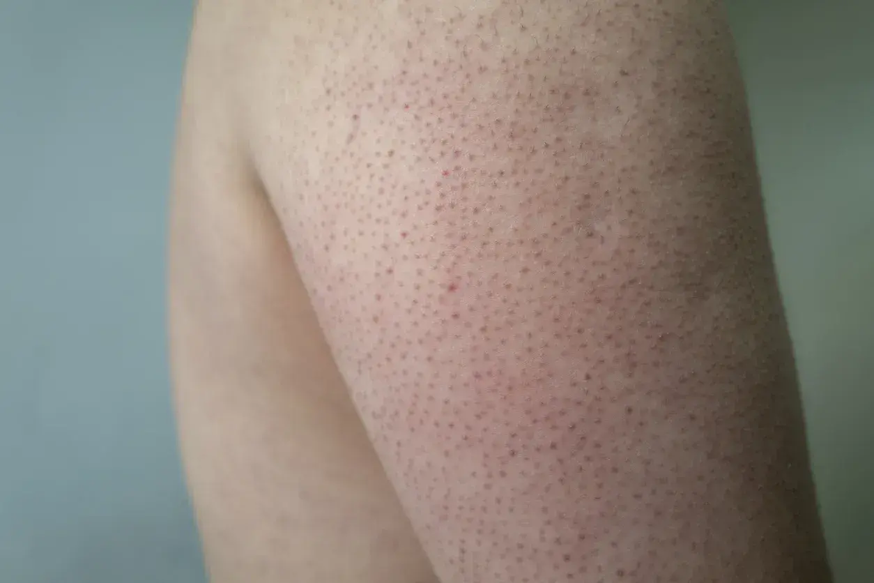 Närbild på en arm med keratosis pilaris hos ett barn. Små röda prickar syns över huden.