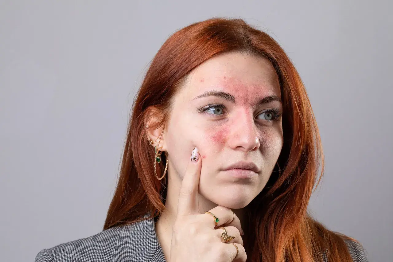 Czerwona wysypka na twarzy młodej kobiety, przypominająca objawy tocznia. Czy toczeń ile się żyje?