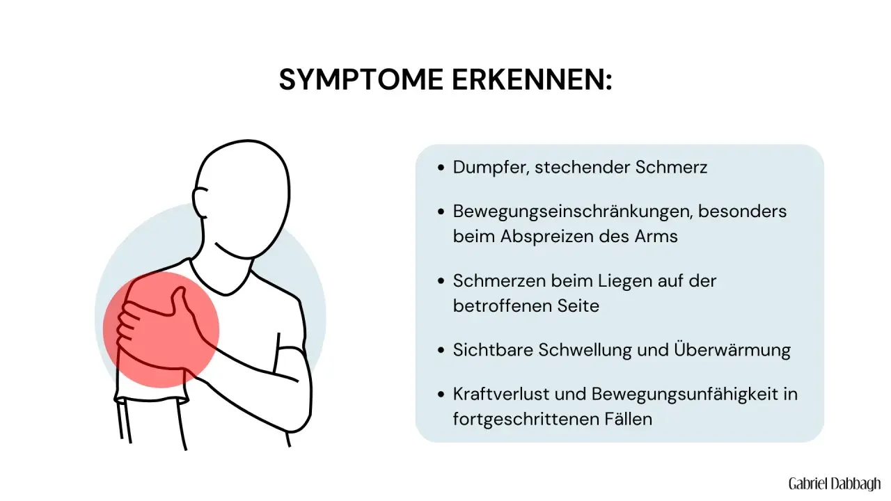 Schulter mit rotem Kreis, der auf Schmerz hinweist. Symptome wie dumpfer Schmerz und Bewegungseinschränkungen bei Schleimbeutelentzündung der Schulter.