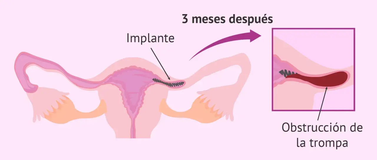 Ilustración muestra un implante en la trompa de Falopio, que causa obstrucción. Esto es un método de ligadura de trompas.