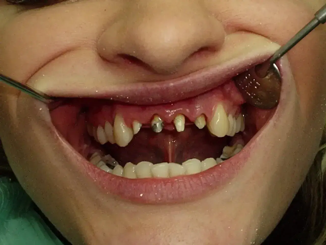 Usta z widocznymi zębami, niektóre wymagają leczenia. Widać fragmenty narzędzi dentystycznych. Planowana jest korona porcelanowa.