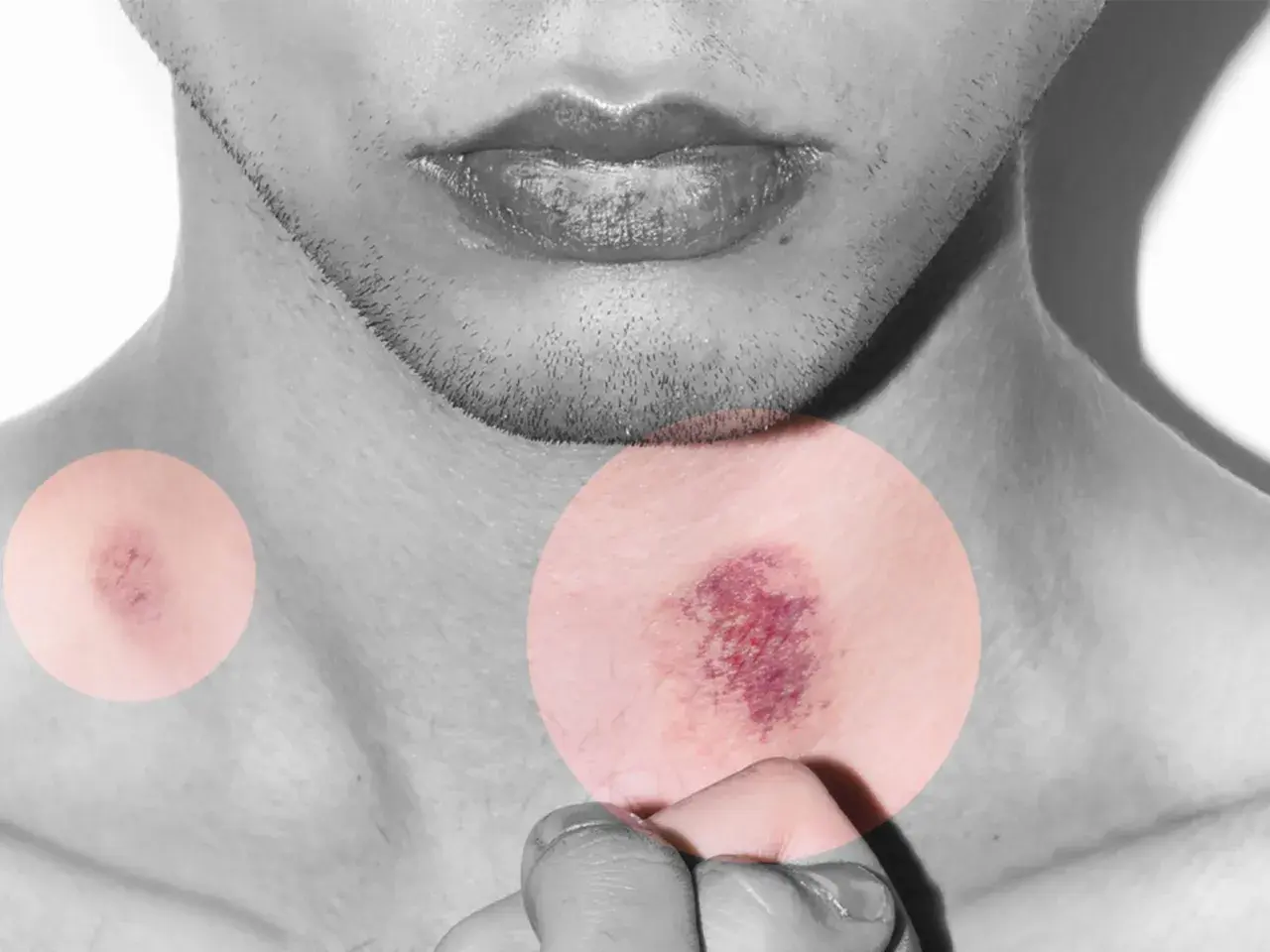 Primer plano de un cuello con dos moretones resaltados en círculos. La imagen sugiere la pregunta: cuanto tarda en irse un chupetón.