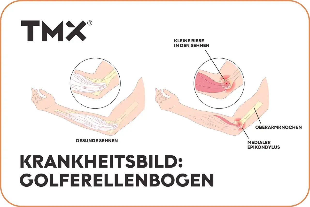Vergleich gesunder und entzündeter Sehnen am Ellenbogen, der Golferellenbogen-Symptome zeigt. Kleine Risse in den Sehnen sind sichtbar.