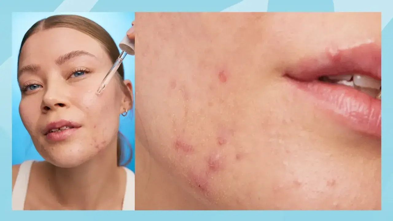 Närbild på hud med keratosis pilaris i ansiktet, där en pipett applicerar serum.