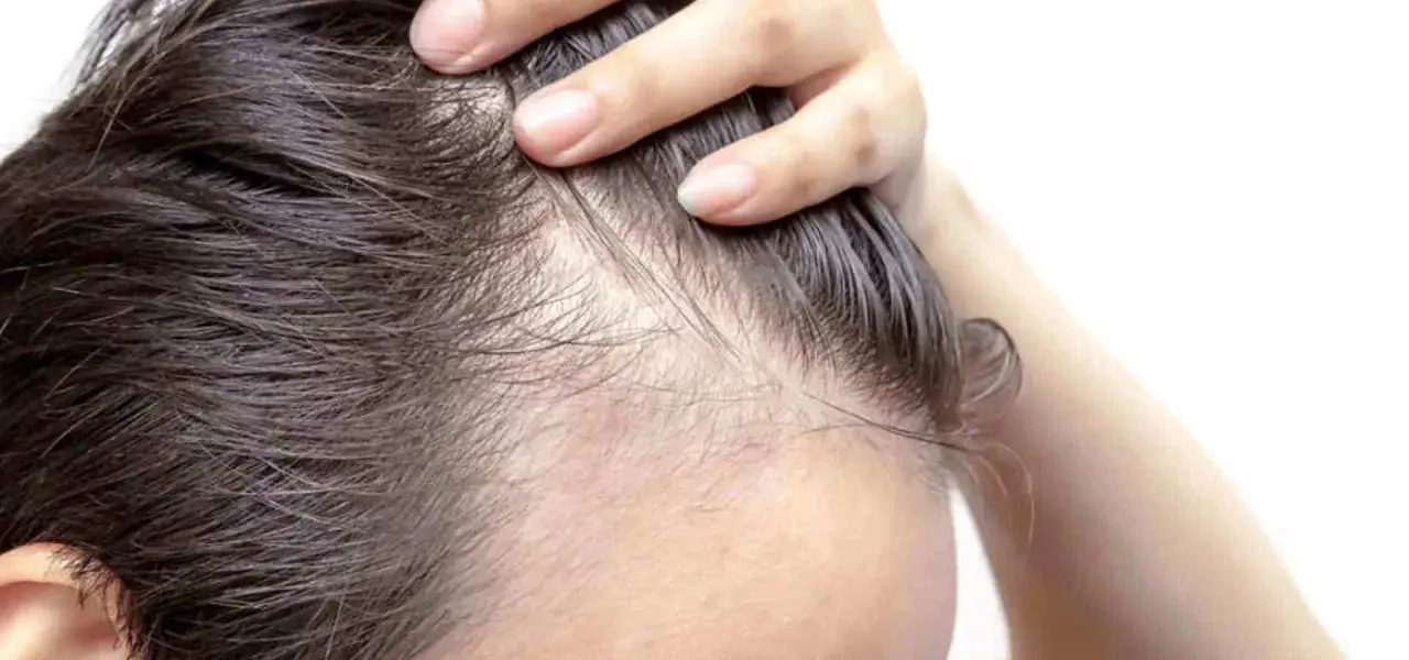 Dita che sfiorano la cute, evidenziando diradamento e sottili capelli. Un segno visibile di alopecia da stress.